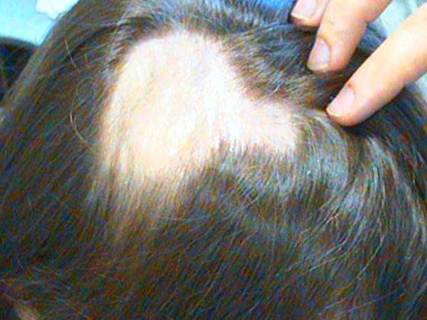 Что делать, если сильно выпадают волосы на голове у женщин?