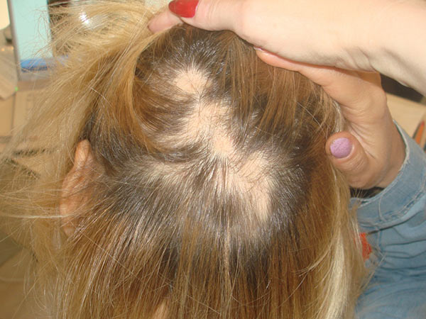 Почему выпадают волосы у женщин на голове?
